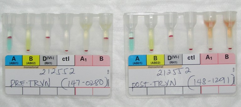 Clinical Significance of a Negative DAT – Dr. Zeyd Merenkov